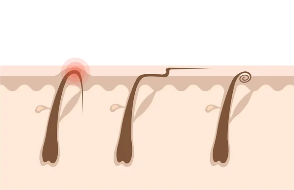 Types Ingrown Hairs Flat Illustration Cross Section Human Skin Hair — Stock Vector