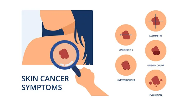 Skin Cancer Symptoms Big Diameter Asymmetry Uneven Color Uneven Border — Vector de stock