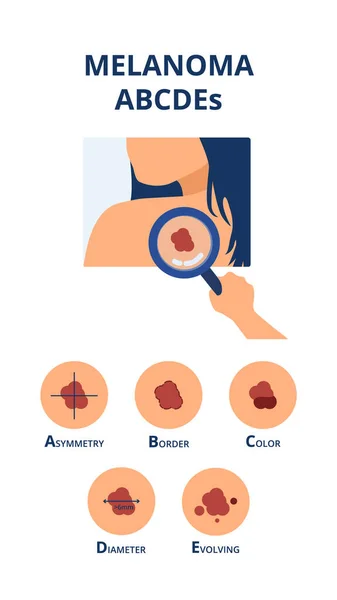 Melanoma Abcdes Symptoms Big Diameter Asymmetry Uneven Color Uneven Border — Vector de stock