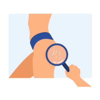 Kalçasında gerilme izleri olan ve elinde büyüteç olan bir kadın vücudu. Kadın bacaklarında çizgiler. Vücut pozitifliği, güzellik, cilt konsepti