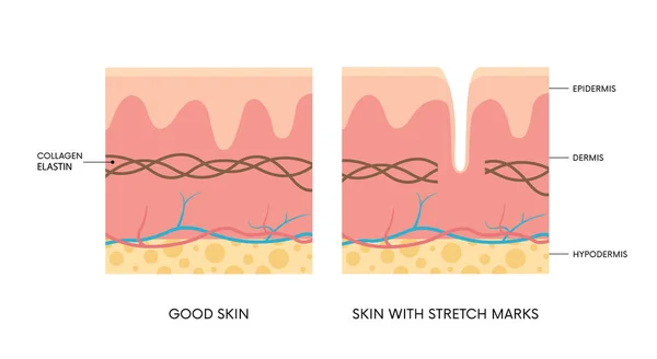 有或没有伸展痕迹的皮肤解剖 胶原蛋白弹力素纹状体体征 护肤观念 — 图库矢量图片
