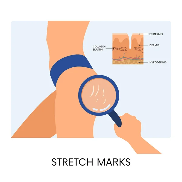 腰にストレッチマークを持つ女性の体と拡大鏡や皮膚解剖図と手 女性の腰にストライプ 体の積極性 美しさ スキンケアの概念 — ストックベクタ