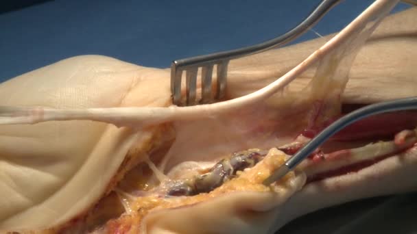 Chirurgia na sali operacyjnej — Wideo stockowe