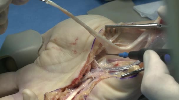 Χειρουργική επέμβαση σε μια αίθουσα εκμετάλλευσης — Αρχείο Βίντεο
