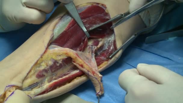 Хирургия в операционной — стоковое видео