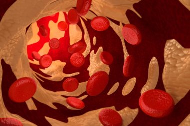 Arteriosclerosis by Cholesterol Plaque, 3D Rendering clipart
