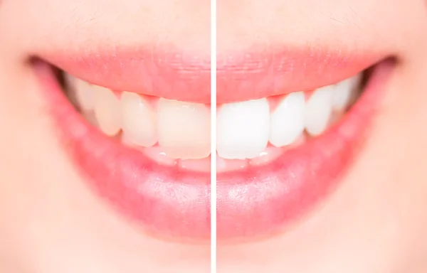 Close-up teeth female between before and after brush the teeth, — Stock Photo, Image