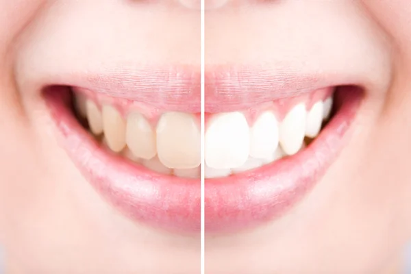 Close-up teeth female between before and after brush the teeth. — Stock Photo, Image