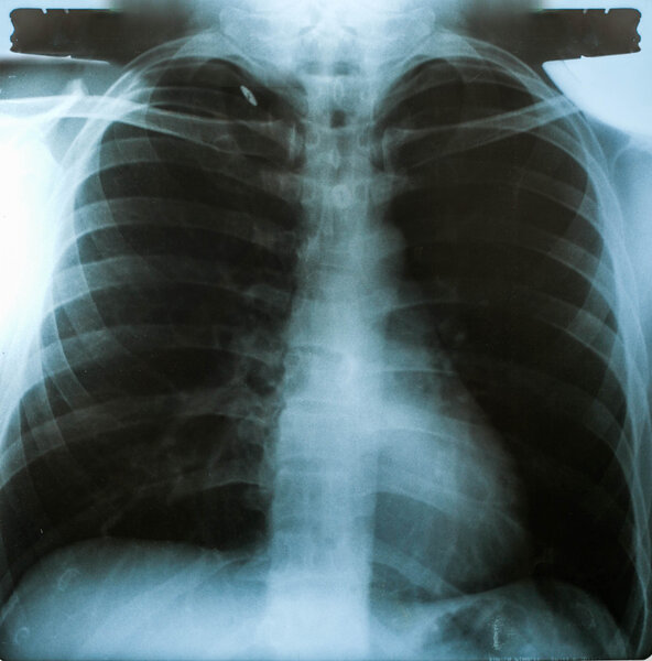 X-Ray image, View of chest men for medical diagnosis.