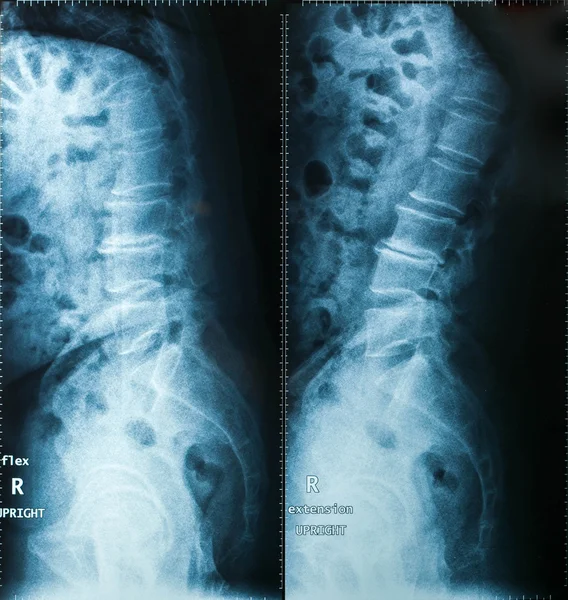 X-Ray image, View of neck men for medical diagnosis. — Stock Photo, Image