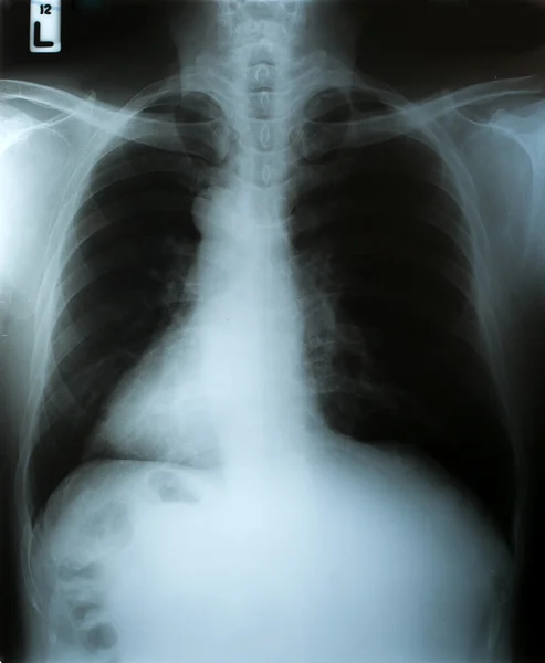 X-Ray image, View of chest men for medical diagnosis. — Stock Photo, Image