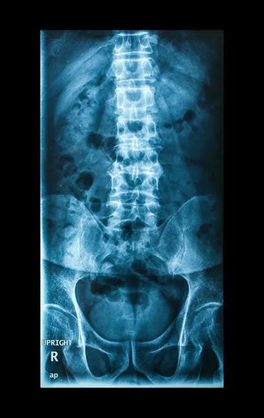 X-Ray image, View of backbone men for medical diagnosis. — Stock Photo, Image