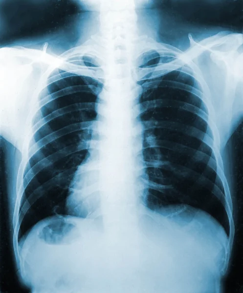 Imagen de rayos X, Vista de hombres del pecho para el diagnóstico médico . —  Fotos de Stock