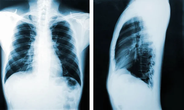 X-Ray image, View of chest men for medical diagnosis. — Stock Photo, Image