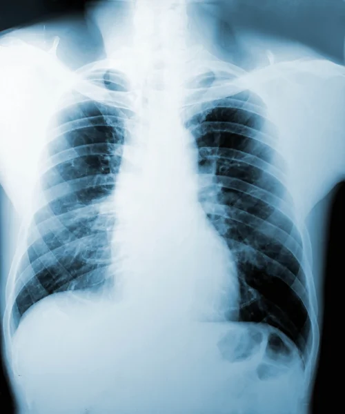 X-Ray image, View of chest men for medical diagnosis. — Stock Photo, Image