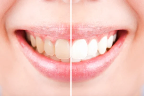 Nahaufnahme der Zähne weiblich zwischen vor und nach dem Zähneputzen, — Stockfoto