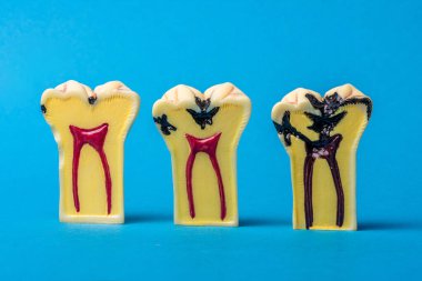 Diş modelleri, diş eti hastalığının aşamalarını ve acil diş bakımı ihtiyacını temsil eden, sağlıklı bir dentin yapısından, hamura ulaşan ciddi diş çürümesine kadar olan süreçleri gösteriyor.