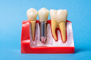 Diş implantı modeli, protez implantın yanında sağlıklı bir diş yapısını gösteriyor. Ağız sağlığı, modern dişçilik ve dişler için restorasyon seçeneklerini gösteriyor.