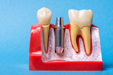 Diş implantını kaplama ve doğal diş yapılarıyla detaylandıran sözlü anatomi modeli, diş protezi ve yenileme ve diş hekimliği sürecini gösteriyor