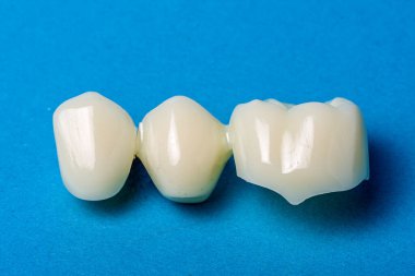 Mavi arka planda üç kaplamalı porselen diş köprüsü protezi gösteriliyor. Kayıp dişler için gelişmiş bir çözümü temsil etmek ve gelişmiş oral işlevleri ve doğal gülümsemeleri teşvik etmek.