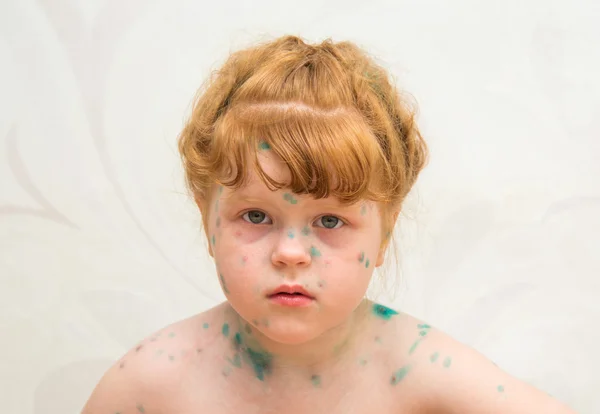 Menina, uma varicela doente — Fotografia de Stock