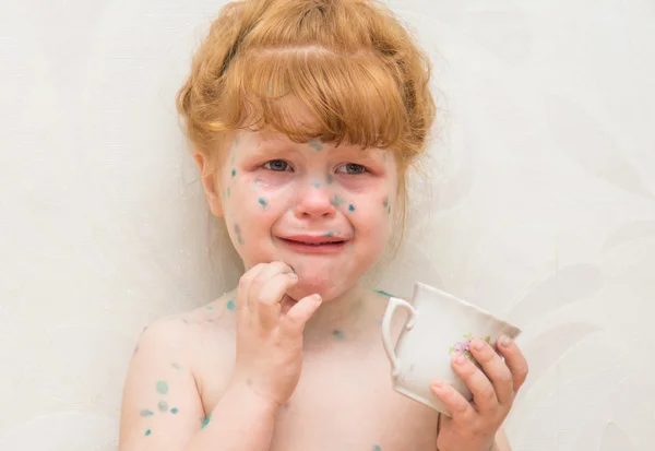 Menina, uma varicela doente — Fotografia de Stock