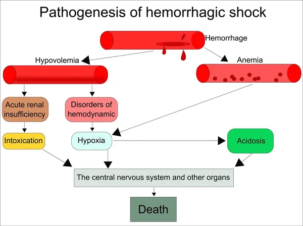 Patogénesis del shock hemorrágico — Vector de stock