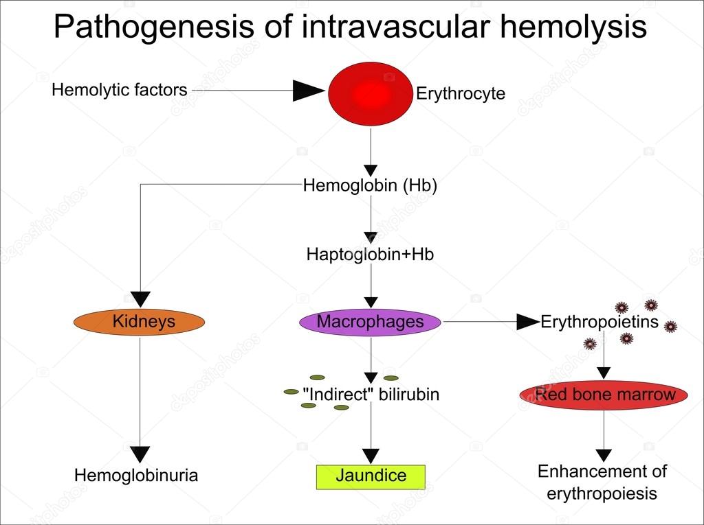 Pathogenèse de l'hémolyse intravasculaire image vectorielle par sandro