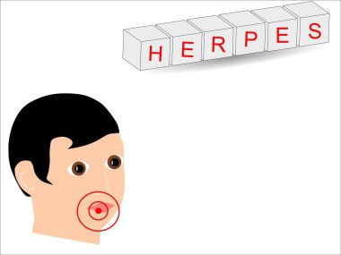 Herpes olan bir adam