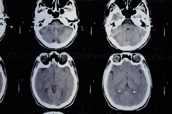 Datortomografi av huvudet — Stockfoto