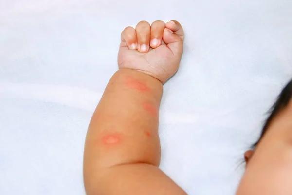 Рука Младенца Белой Ткани Укусы Комаров Вызвать Лихорадку Денге — стоковое фото