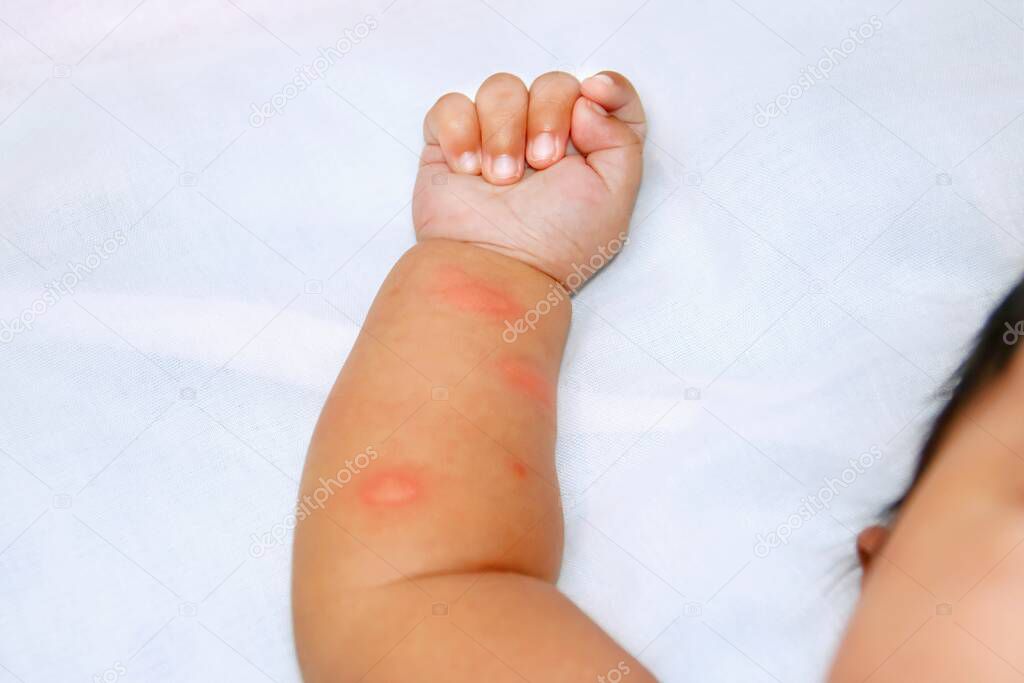 Baby arm on white fabric have a mosquito bites may cause dengue fever