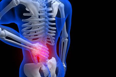 3D resimleme - sırt ağrısı