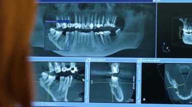 Doktor dişçisinin yakın çekimi hastaların röntgenlerine bakar çene ve dişler monitörde