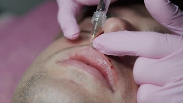 Een man die schoonheidsinjectie krijgt voor lippen. Close-up van de handen van de cosmetoloog die injecteert in mannelijke lippen. Lipvergroting — Stockvideo