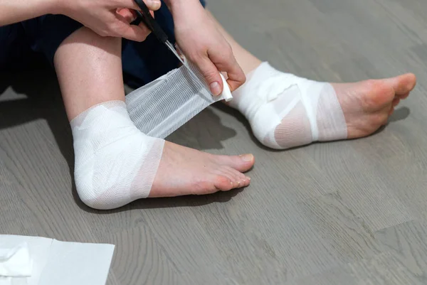 Callus na nodze. Dziewczyna używa maści, plaster i bandaż w leczeniu rozmówcy — Zdjęcie stockowe