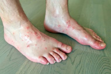 Erkeklerin ayak derilerindeki sivrisinek ısırıklarına yakından bakın..