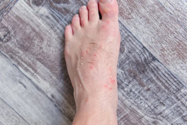 Zbliżenie na wiele ukąszeń komara na skórze stóp mężczyzn. — Zdjęcie stockowe