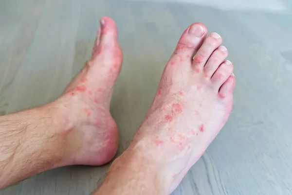 close up on many mosquito bites on mens foot skin.