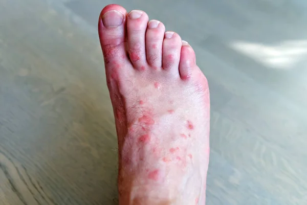 Zbliżenie na wiele ukąszeń komara na skórze stóp mężczyzn. — Zdjęcie stockowe