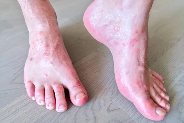 Close up on many mosquito bites on mens foot skin. — Stock Photo, Image