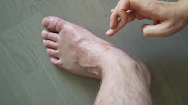 Muchas picaduras de mosquitos en las piernas. Reacción alérgica, dermatitis. Mujer mano está aplicando ungüento en la piel. — Vídeo de stock
