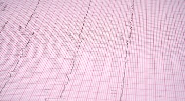 Ekokardiyograf test raporunu kapat (EKG) anormal kalp ritmi gösteriyor.