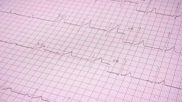 Ekokardiyograf test raporunu kapat (EKG) anormal kalp ritmi gösteriyor.