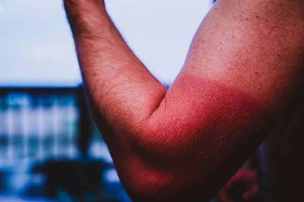 Braccio con visibile scottatura solare rossa causata dall'uso di una camicia — Foto Stock