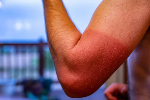 Braço com queimadura solar vermelha visível causada pelo uso de uma camisa — Fotografia de Stock