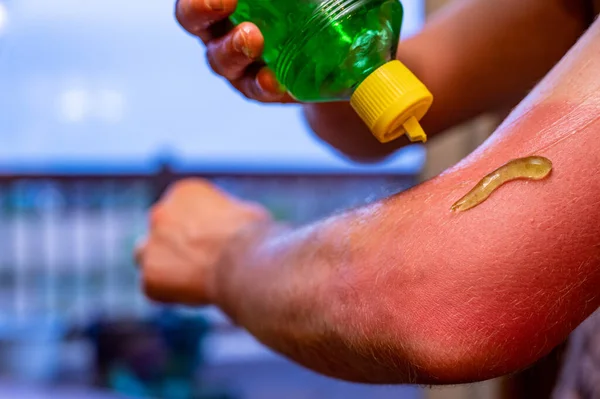 Applicando il gel di aloe vera a una scottatura del sole rossa su un braccio — Foto Stock