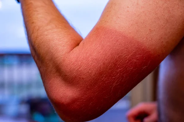 Braccio con visibile scottatura solare rossa causata dall'uso di una camicia — Foto Stock