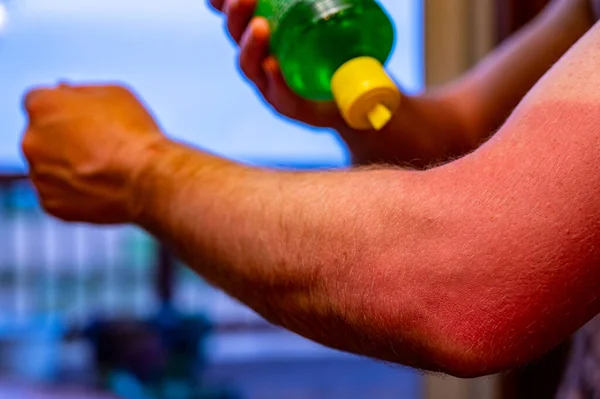 Applicando il gel di aloe vera a una scottatura del sole rossa su un braccio — Foto Stock