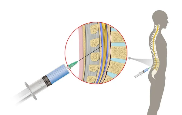 Lumbar Puncture Also Known Spinal Tap Medical Procedure Which Needle — Stock Photo, Image